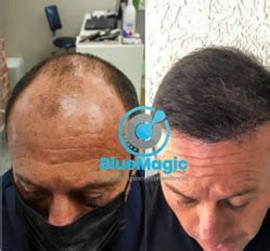 All you need to know about Blue Magic Hair Transplantation Cost in Turkey